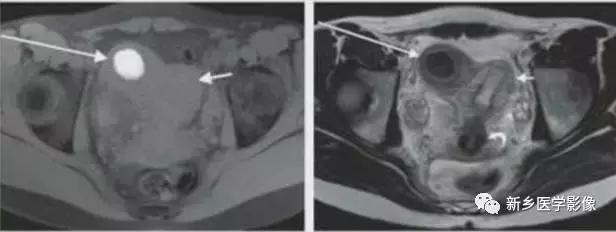 子宫发育异常,应想到的6大类常见畸形