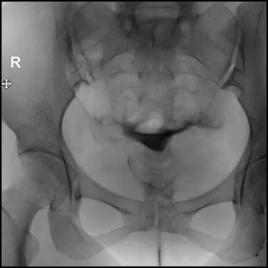三亚妇幼保健院输卵管造影无痛,石家庄哪个医院有无痛输卵管造影