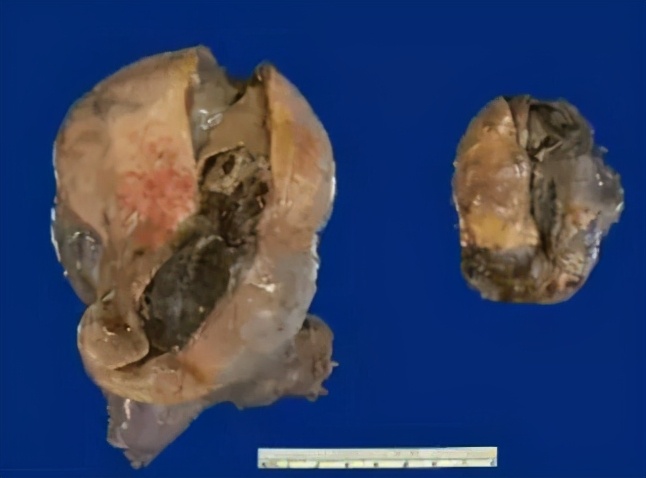 畸胎瘤里面为什么有毛发和骨骼,畸胎瘤为什么有毛发和骨骼