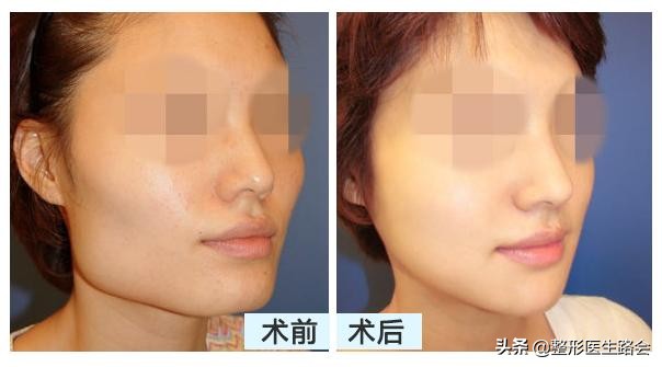 下颌角大瘦脸前后对比,下颌角宽的脸方怎么达到视觉效果