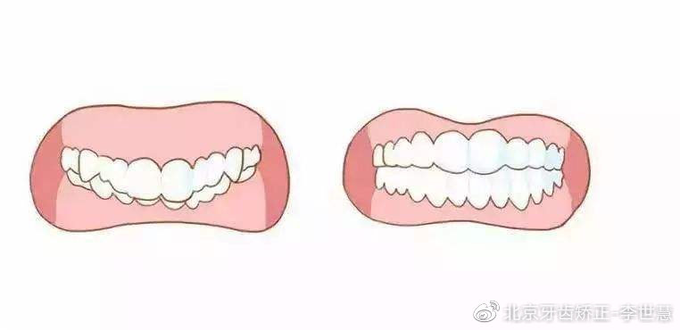 怎样判断龅牙是牙性还是骨性,怎么判断是牙性龅牙还是骨性龅牙