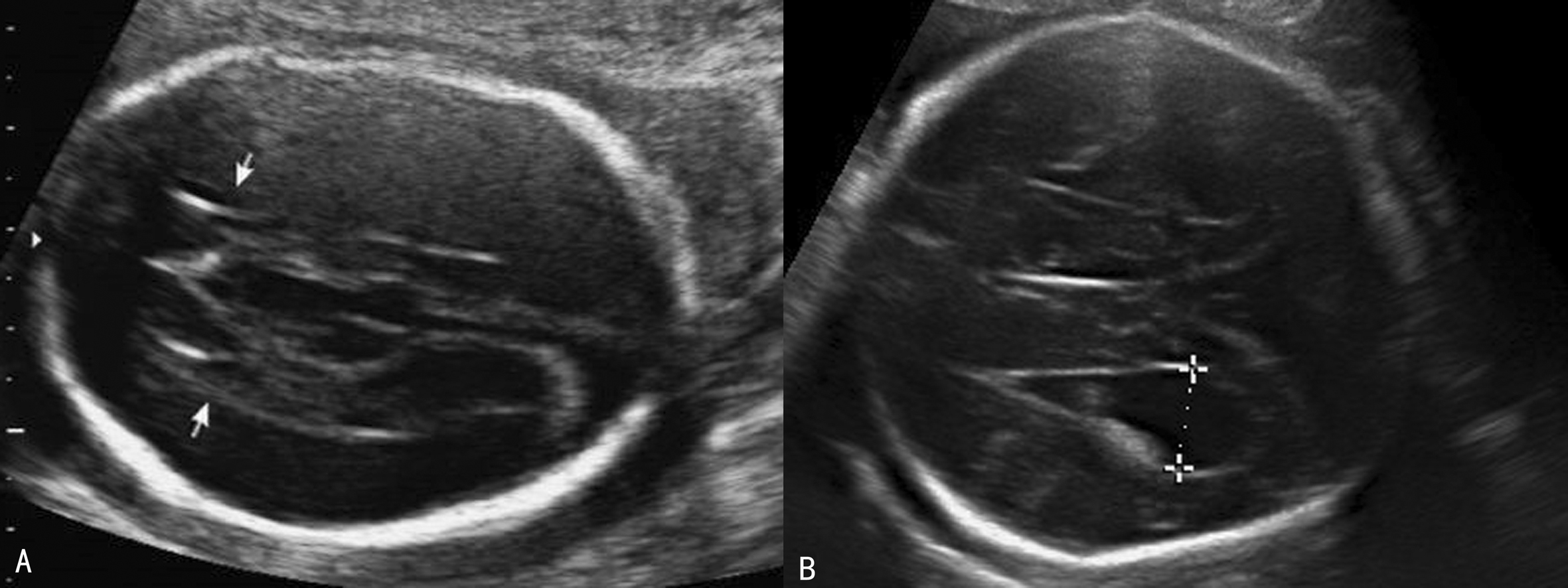 胎儿颅脑结构及心脏结构异常,胎儿颅脑形态及结构异常