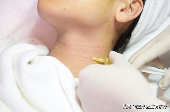 你的皱纹是怎样的,你的颈纹是这样的吗