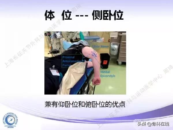 肘关节镜手术后引流,肘关节镜微创手术