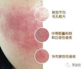 接触性皮炎的症状表现,化妆品接触性皮炎图片