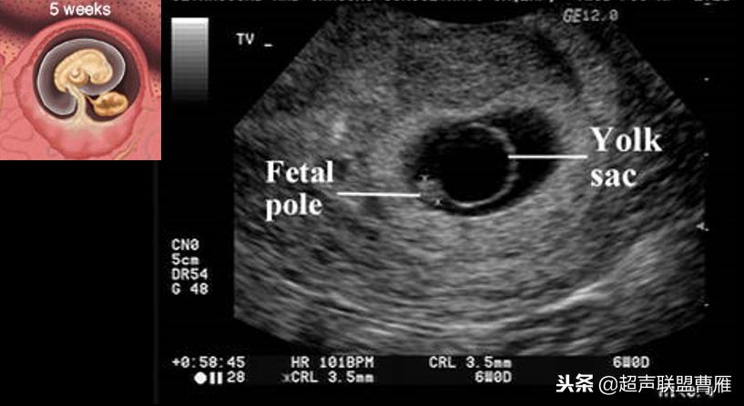 内见卵黄囊,卵黄囊肿瘤