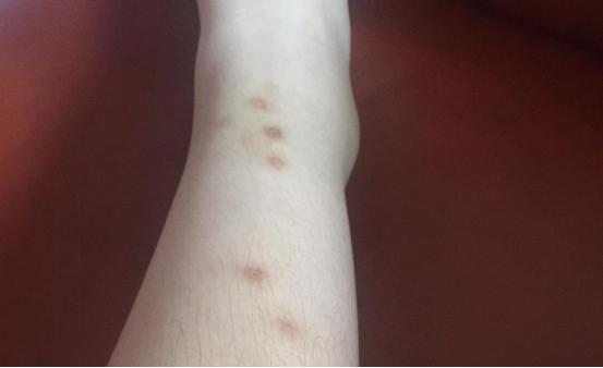 夏季蚊虫咬留疤怎么办,夏天蚊虫叮咬的疤会留白印吗