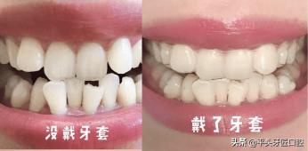 牙齿矫正需要多少时间完成,牙齿矫正后需要戴保持器多长时间