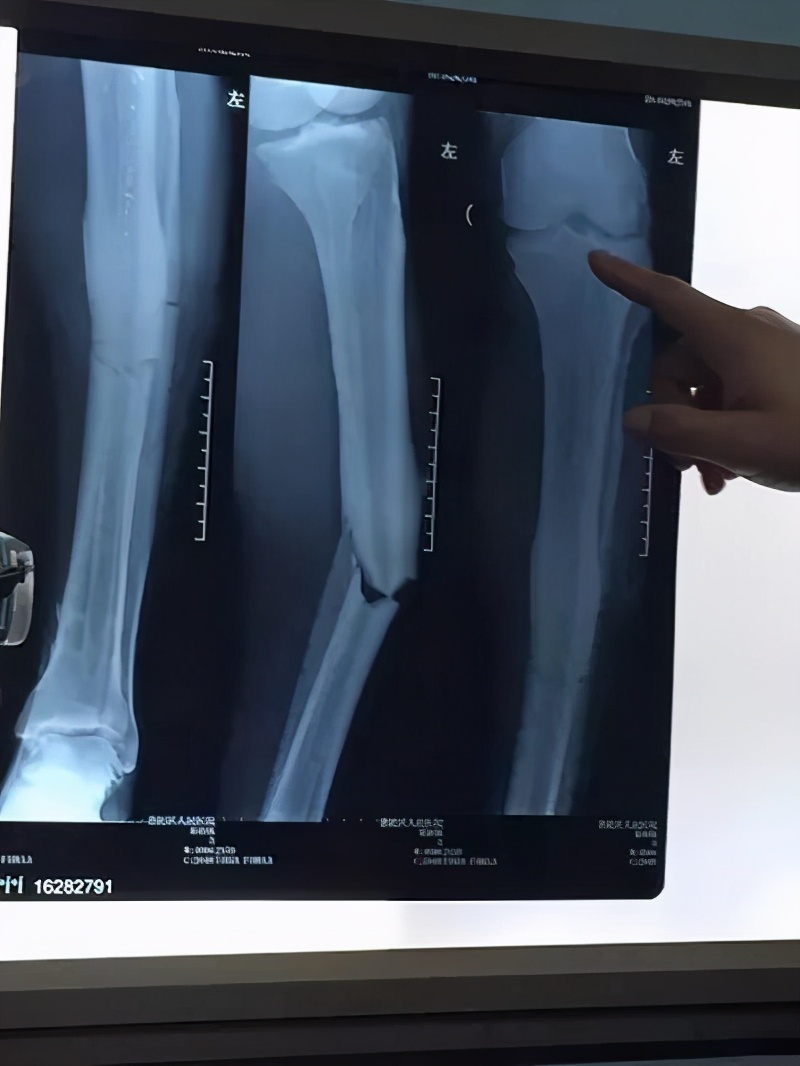 登巴巴受伤事件的反思,登巴巴小腿严重受伤