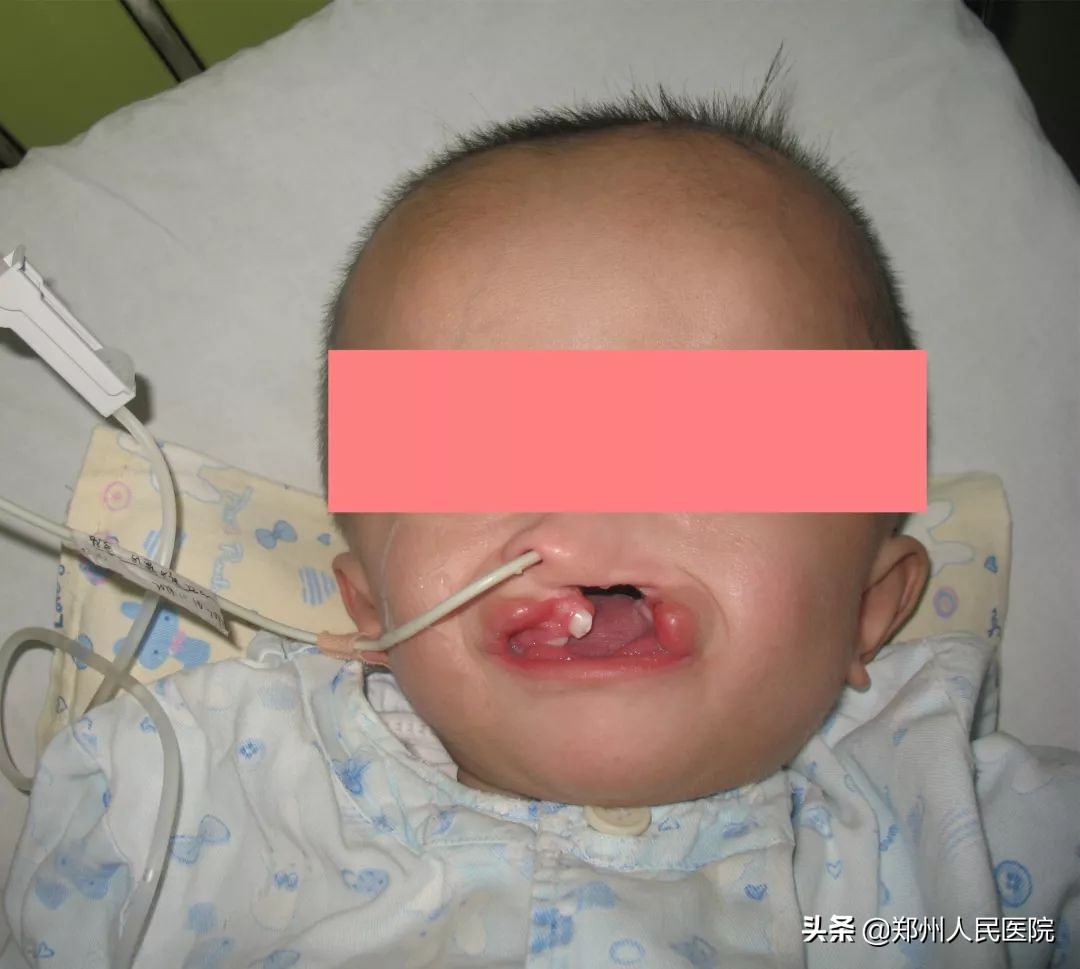 严重唇腭裂修复效果,唇裂修复对比照片