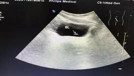 细菌感染血液检查结果,布鲁氏杆菌感染抽血检验