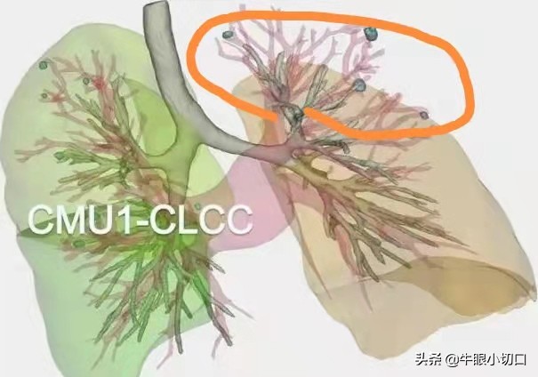 磨玻璃影肺腺癌切除最佳时机,肺磨玻璃结节ggo和ggn各表示什么