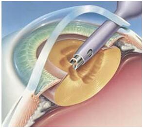 核性白内障与普通白内障手术区别,飞秒白内障与普通白内障手术