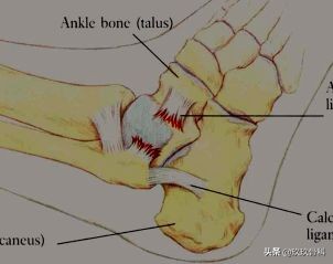 陈旧性踝关节损伤的治疗,踝关节损伤现场处理视频