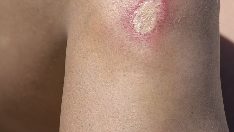 疤痕性白斑是白癜风吗,继发性白癜风和白癜风有什么区别