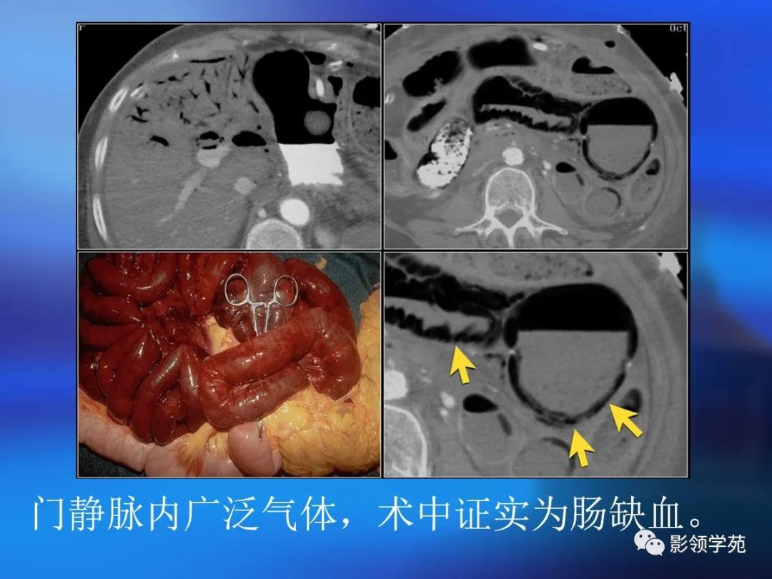 肠道内壁增厚,肠道扩张ct表现
