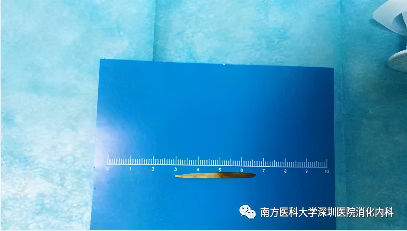 小肠异物取出手术步骤,小肠异物穿孔微创手术