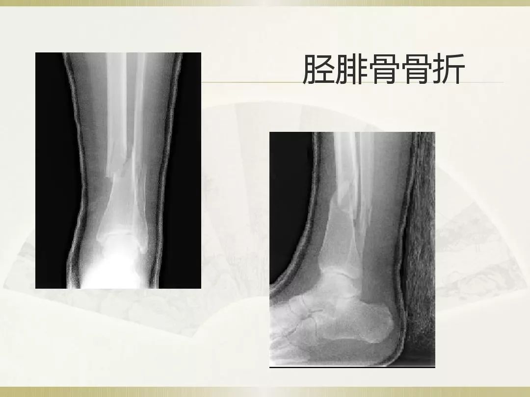 骨科x光片读片技巧,放射科骨科读片教程