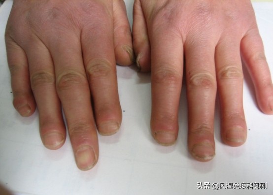 硬皮病要注意哪些日常保养,硬皮病的健康指导