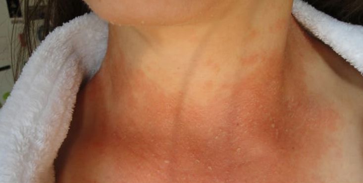 念珠菌怎么预防,如何防治念珠菌