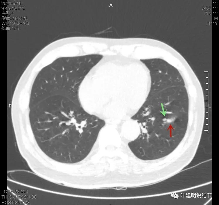 肺上有实性结节6mmx5mm是什么原因,肺上有1.7x1.8的实性结节该怎么办