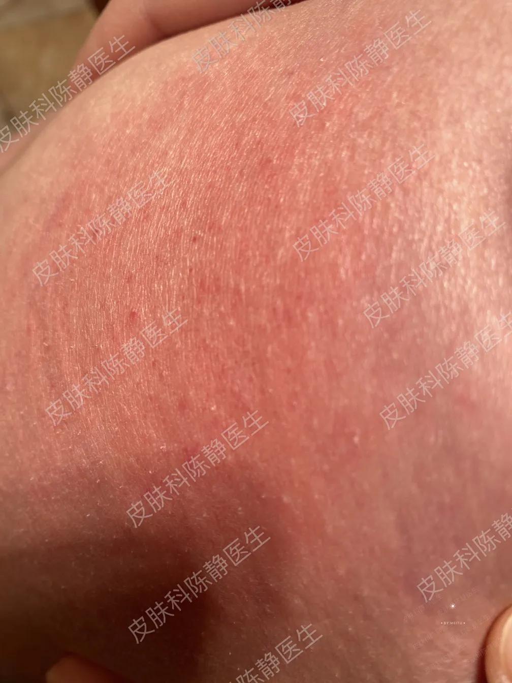 消毒液致皮肤病,皮肤病消毒