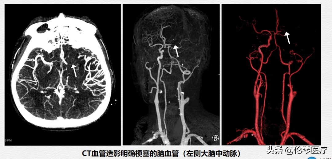 伦琴医疗核心专家王悍教授:脑中风是怎么回事,如何预防与治疗?