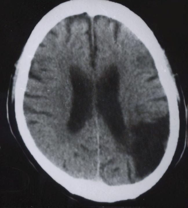脑梗后癫痫会致人死亡吗,脑梗死的癫痫会引起牙齿痛吗