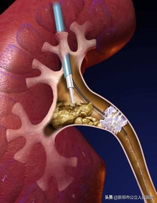 尿结石腰疼说明石头在哪里卡着呢,腰疼得厉害小便血尿是怎么回事