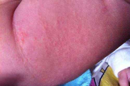 宝宝红臀最有效的治疗方法,关于红臀怎样预防和处理