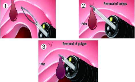 胃病转癌的六大征兆,胃病一直不好发展下去变癌吗