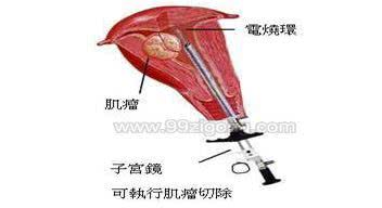 多发性肌瘤必须做子宫切除手术吗,10公分大肌瘤能微创手术吗