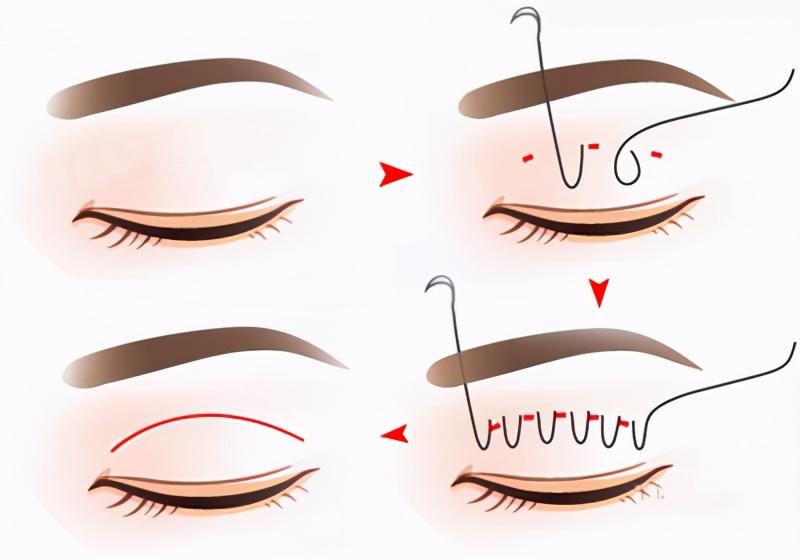 割双眼皮后变单眼皮,微创双眼皮恢复变三眼皮