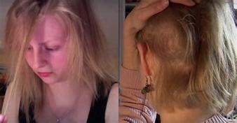 拔毛癖好治吗,怎么能戒掉拔毛癖