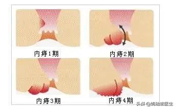 哪些疾病可使得肛门脱出呢？