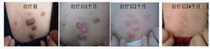 锶敷贴治疗血管瘤,90锶敷贴治疗血管瘤费用