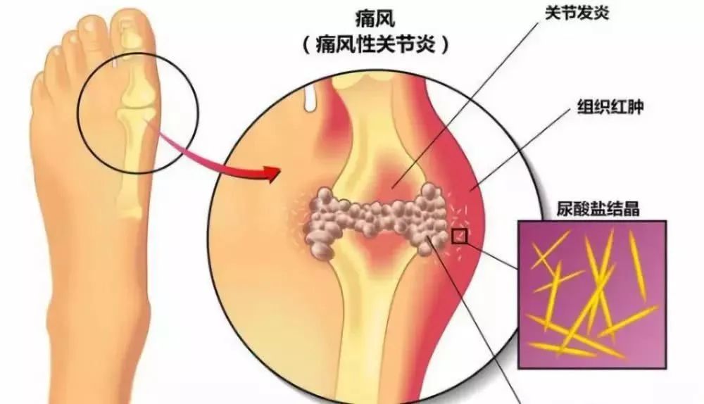 初次痛风尿酸盐结晶多长时间消失,痛风发作后尿酸结晶哪里去了