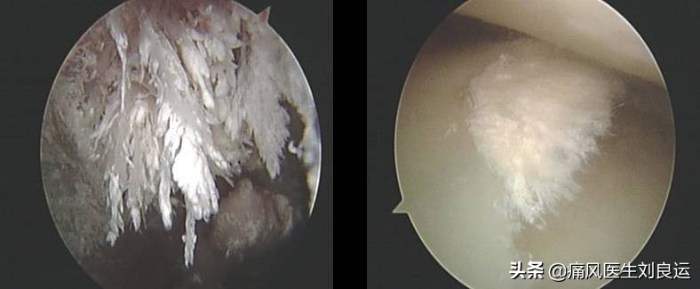 快速降尿酸有“特效药”吗？“根治”痛风的真相你清楚吗？