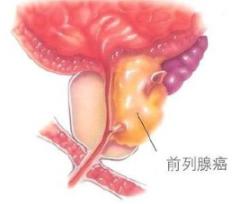 前列腺癌中医治愈率,中医疗法治疗前列腺癌效果好吗