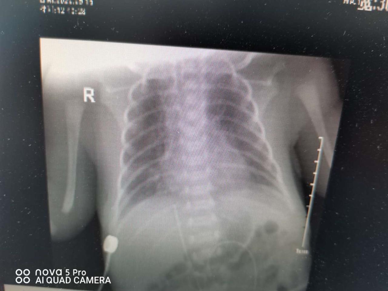 喜报我院,早产儿抢救室用呼吸机