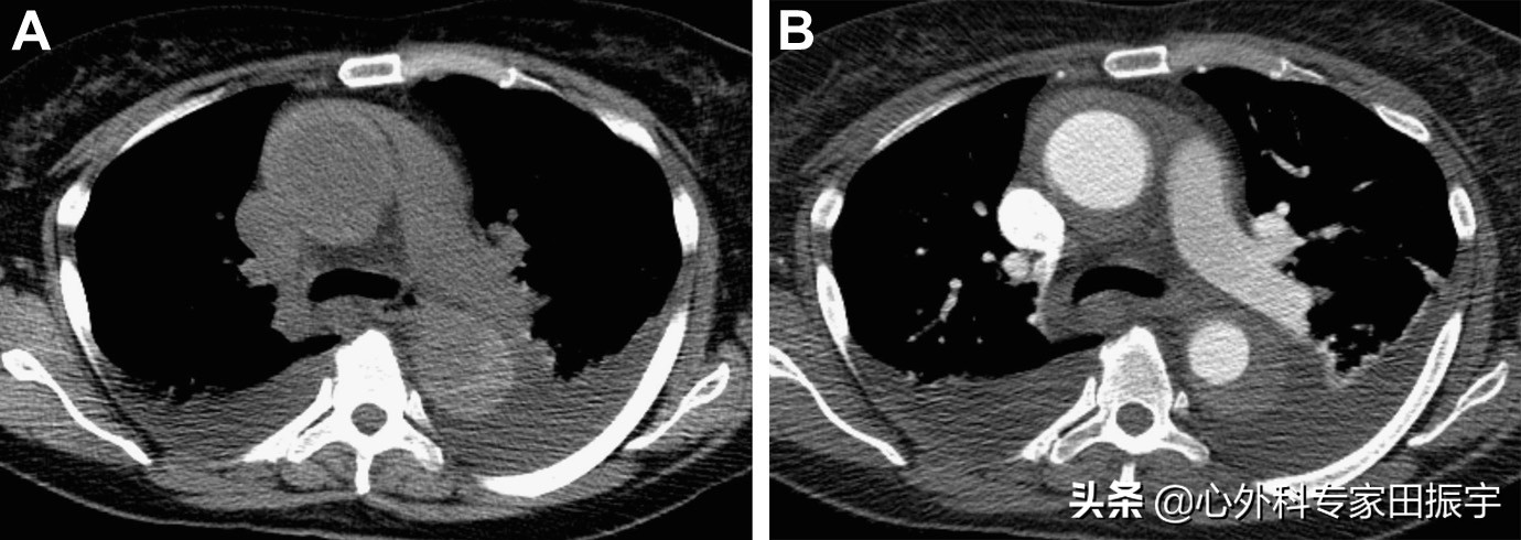 主动脉血肿危险期,高危脑动脉瘤破裂出血