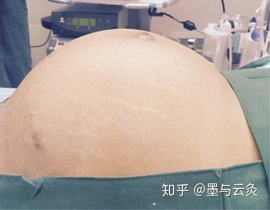 肝硬化腹部积水一般都是癌症,癌症胸腔积液腹部积水能活多久