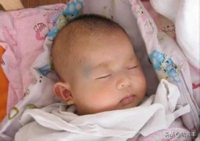 什么是太田痣黑褐色,什么是太田痣医生终于讲清楚了