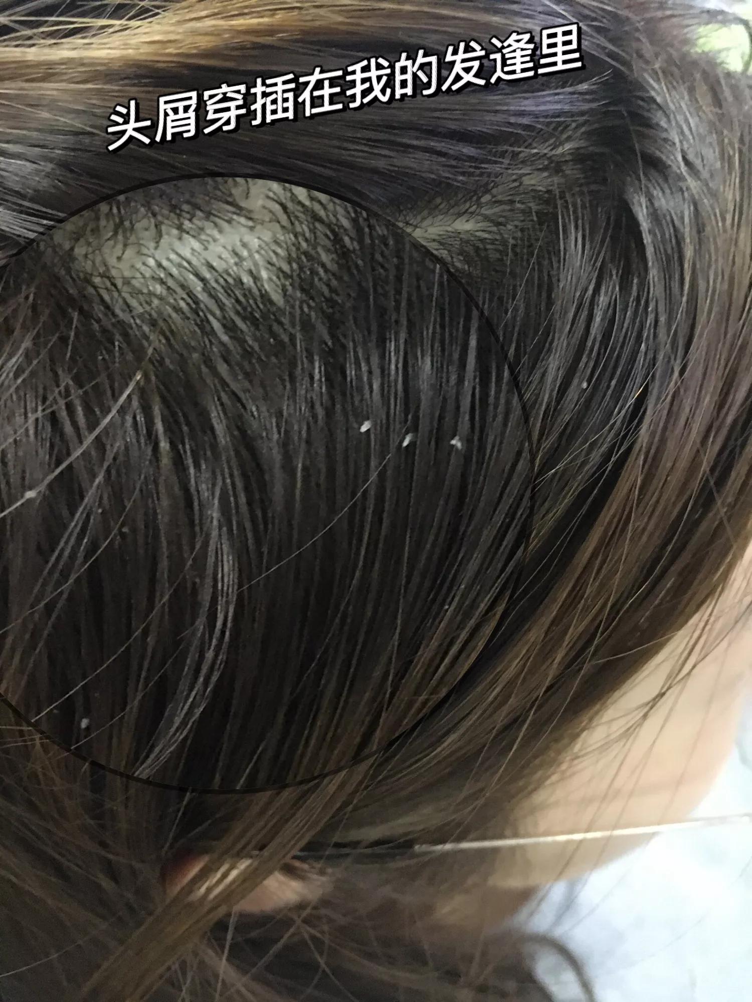 为什么从来没有头屑,你还在为头屑而烦恼吗