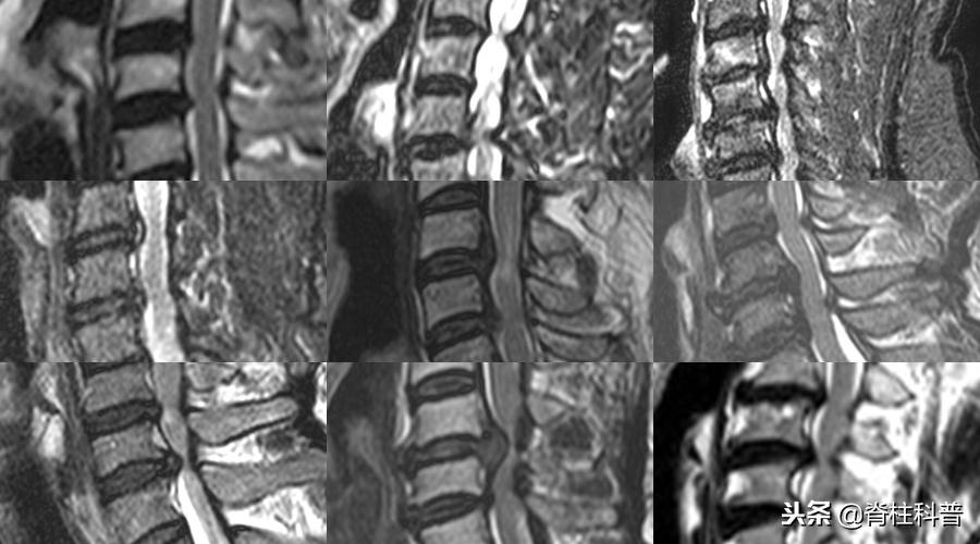 颈椎病治疗的分享,关于颈椎病通俗易懂的科普