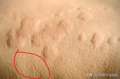 入秋宝宝皮肤突然干燥泛红有疙瘩,小孩手痒脱皮的原因和治疗方法