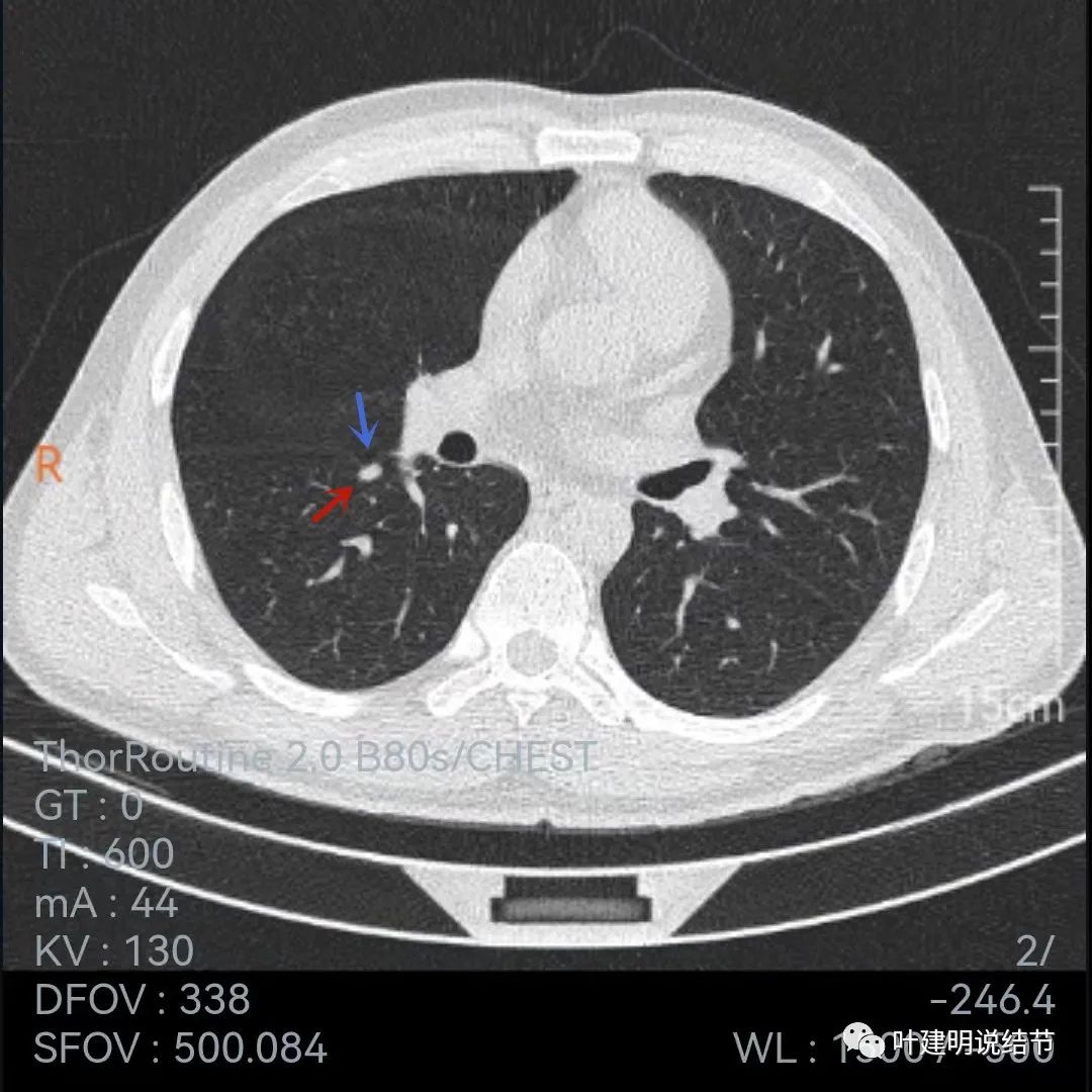 问诊分析：存在了4年的实性结节会不会是肺癌？
