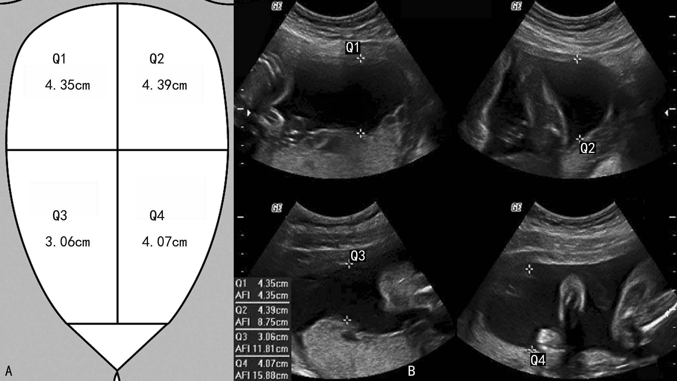 明明白白做超声（十九）：羊水和胎膜超声检查