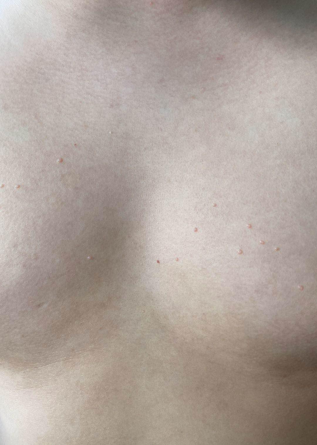 16岁男孩脸上长青春痘了怎么办,12岁男孩子脸上长满青春痘怎么办