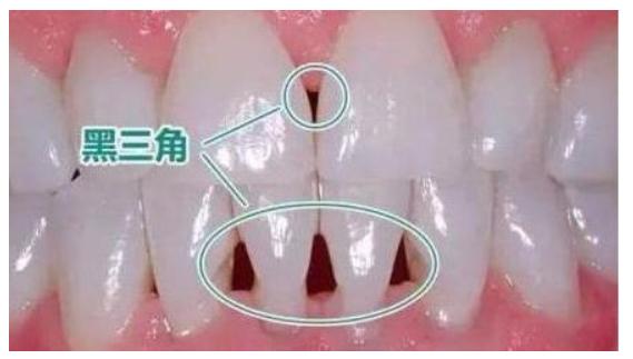 牙齿矫正,你后悔了吗?